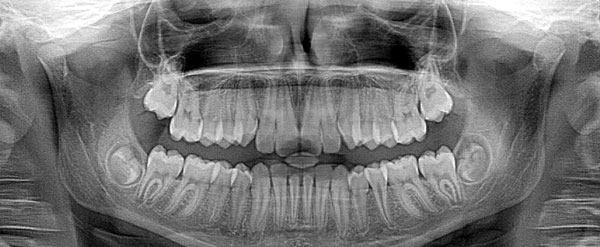Radio dentaire 3d réalisée au cabinet de parodontologie de Saint-Etienne